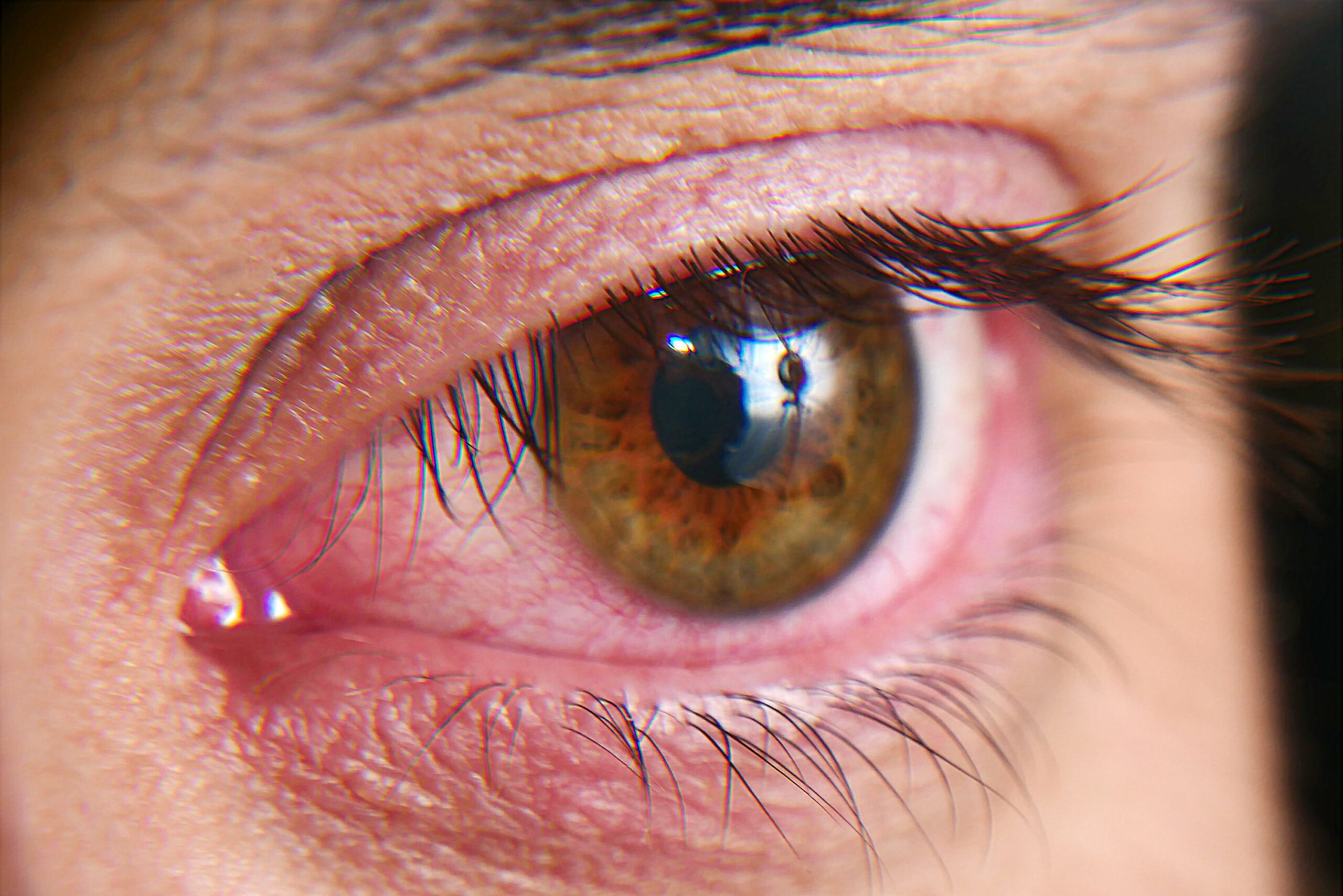 Dry eyes syndrome