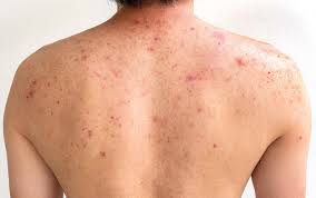 How to Get Rid of Back Acne Scars